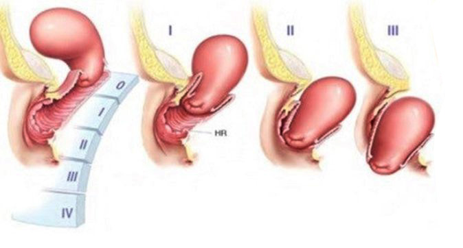 Các cấp độ của sa tử cung sau sinh